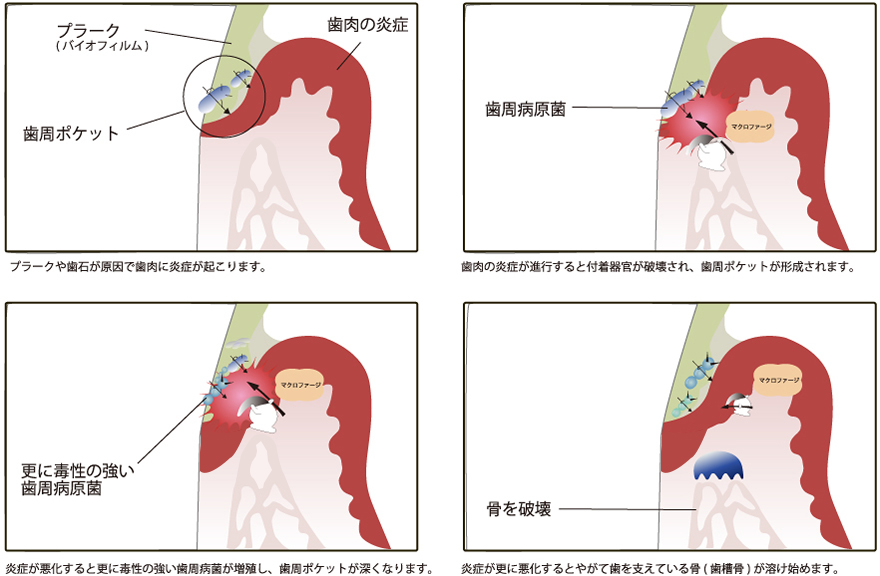 歯周病について