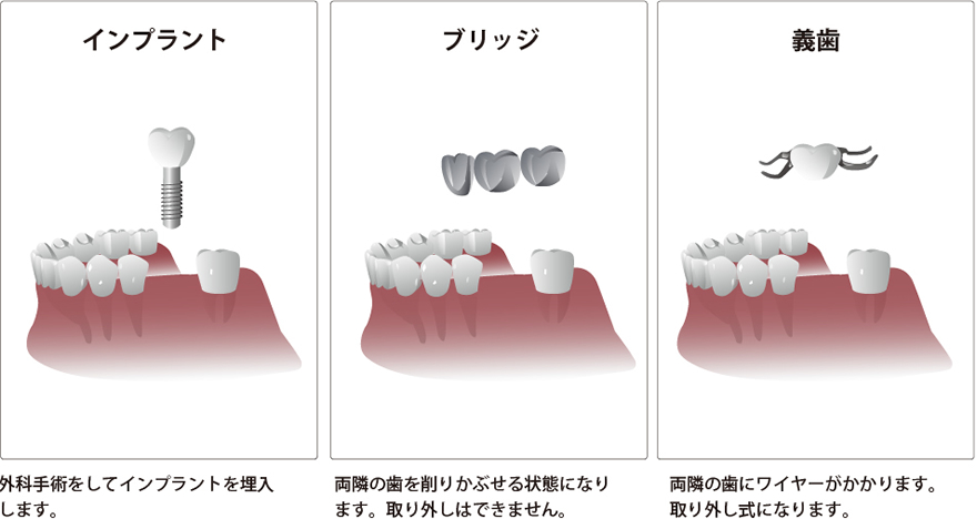 歯周病について
